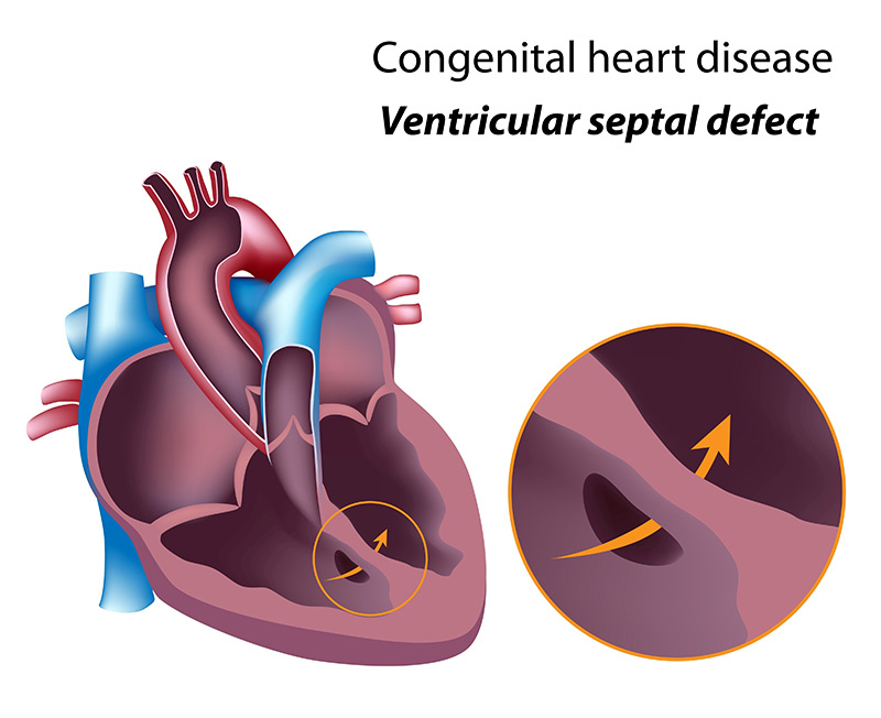 Congenital heart disease heart defect visual